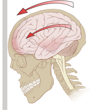 A diagram of the forces on the brain in concussion