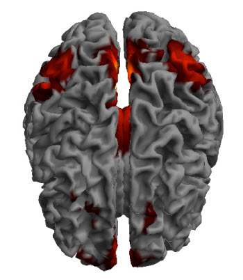 Resting-state functional MRI showing connectivity in the Default Mode Network