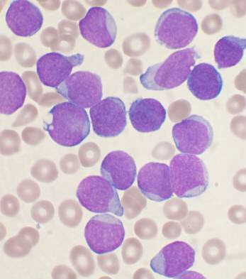 A Wright's stained bone marrow aspirate smear of patient with precursor B-cell acute lymphoblastic leukemia