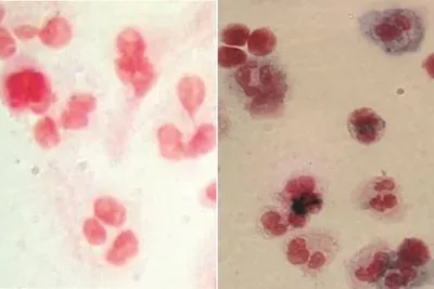 Patient Cells Before and After Gene Therapy