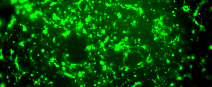 Patient-derived glioma stem cells