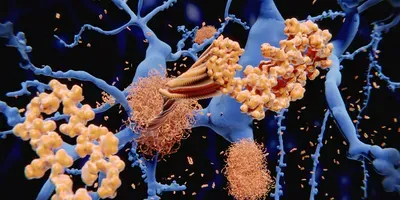 amyloids in Alzheimer's