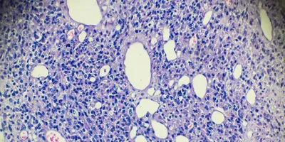 testicular cancer