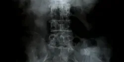 X-ray of spine