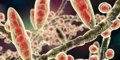fungal infection