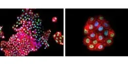 Immunocytochemical analysis of human primary breast cancer cells in vitro, EGFR expression (red) and TP53 (green), DAPI blue
