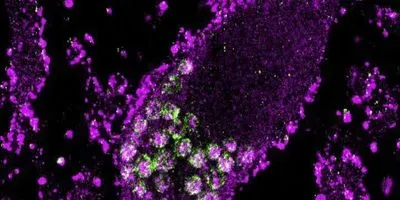 Super-resolution microscopy of a neuron shows the accumulation of lipids within lysosomes that occurs when the gene for prosaposin is suppressed (article image)
