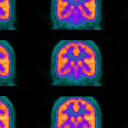 PET scan images of a human brain broken into multiple slices