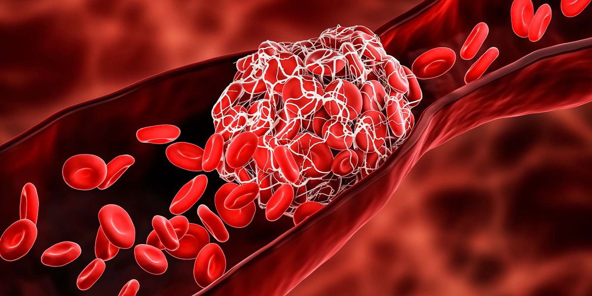 glutathione blood clots and TAM receptor signalling in COVID-19 pathogenesis Autoantibodies Causing COVID-19 Blood Clots