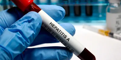Gloved hand holding blood vial labled Hepatits A