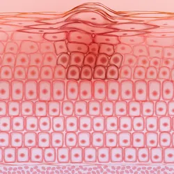 Microscopic shot of cancerous skin cells