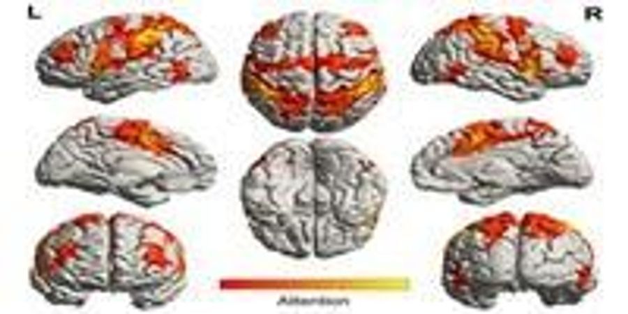 Music Activates Regions of the Brain Spared by Alzheimer's Disease ...