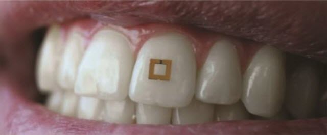 Tiny Sensor Mounted on a Tooth 