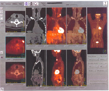 computerized images from PET scanner