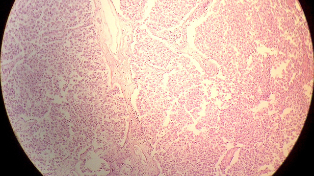 testicular germ cell tumor