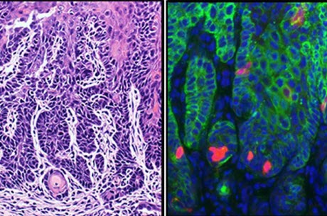 Targeting cancer stem cells improves treatment effectiveness and prevents metastasis