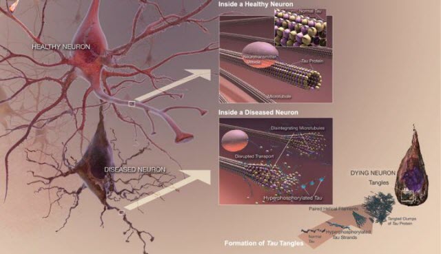 Tau Tangles in a Disease Neuron 