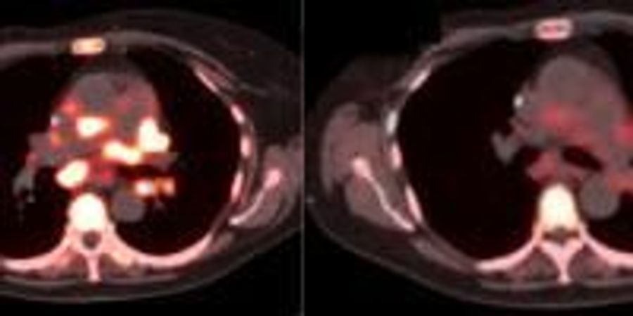 Experts Call for Expansion of Molecular Imaging in Precision Cancer ...