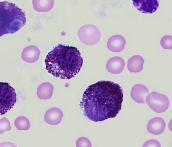 Blood smear with mast cell leukemia