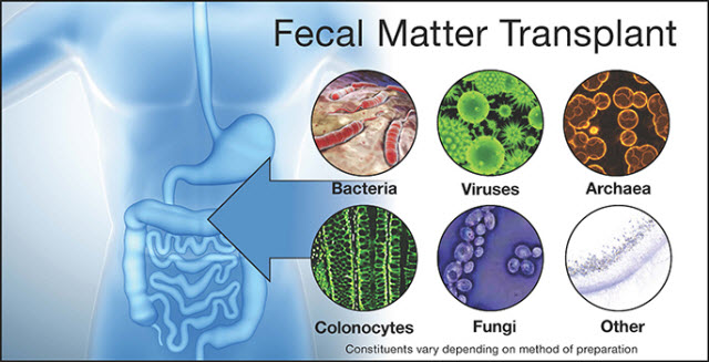 fecal matter transplant