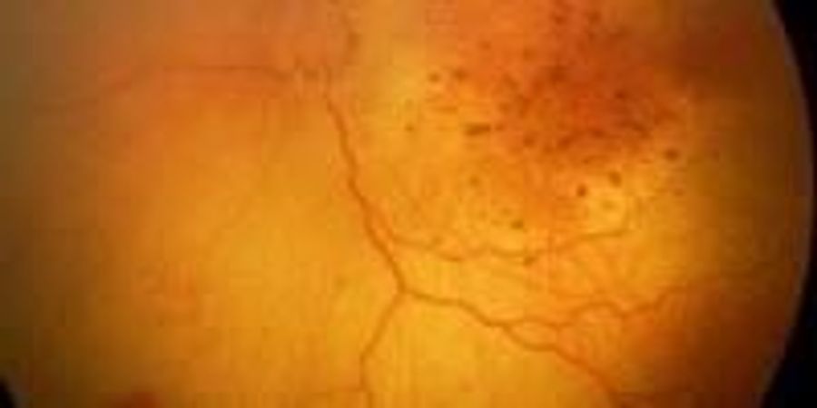 Zika Virus May Be Linked to More Eye Problems in Brazilian Babies with ...