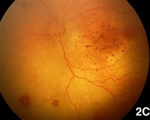 retinal hemorrhaging in a baby with presumed Zika-induced microcephaly