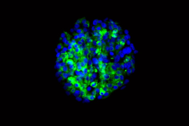  insulin-secreting cells from stem cells derived from the skin of patients with type 1 diabetes