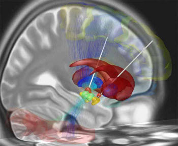 A reconstruction of deep brain stimulation electrodes that have been surgically placed into the most common target structure for treatment of Parkinson’s disease