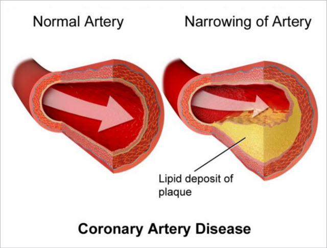 Hops and Coronary Heart Disease