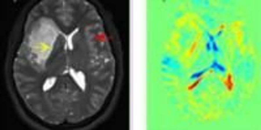 Researchers Use Simple Sugar to Detect Human Brain Tumors | Lab Manager