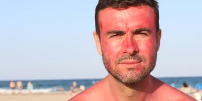 a sunburned man on a beach illustrating the concept that too much sun might make you sick