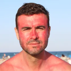 a sunburned man on a beach illustrating the concept that too much sun might make you sick