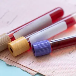 Three test tubes filled with blood lie on a table. New research shows it's possible to detect biomarkers for dementia in blood tests up to a decade before diagnosis