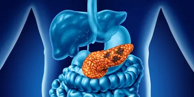 Medical illustration of the human digestive system highlighting the pancreas with dark cancerous regions, representing pancreatic cancer within the gastrointestinal tract.