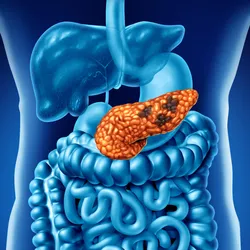 Medical illustration of the human digestive system highlighting the pancreas with dark cancerous regions, representing pancreatic cancer within the gastrointestinal tract.