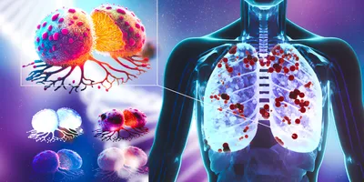 Illustration showcasing cancer cells indicating HER2 mutations in lung cancer