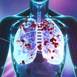 Illustration showcasing cancer cells indicating HER2 mutations in lung cancer