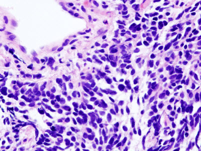Small-cell lung carcinoma