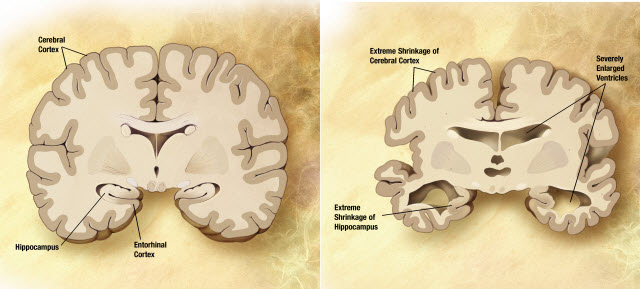 Oxford-led program launches unparalleled resource for dementias research